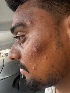 Vineeth before using the protocol