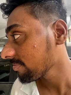 Vineeth after using the protocol