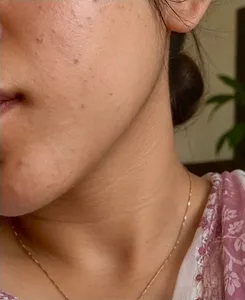 Charitha after using the protocol
